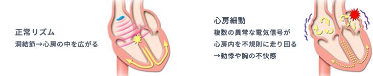 正常リズム：洞結節→心房の中を広がる　心房細動：複数の異常な電気信号が心房内を不規則に走り回る→動悸や胸の不快感